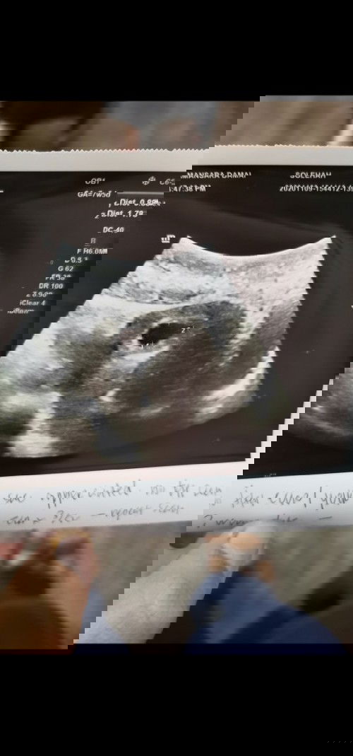 Kalau ikut tarikh period, patut minggu ni da 8w..tp scan mcm 5-6w..normal ke? Mcm jauh sgt je gap😅