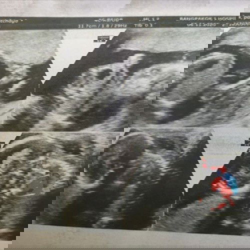 18 สัปดาห์​ 1  วัน  ลูกดิ้นเบา เเละน้อยมาก ครรภ์​ที่  2