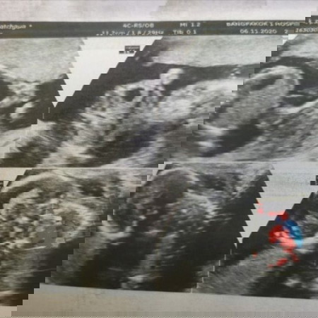 18 สัปดาห์ 1 วัน ลูกดิ้นเบา เเละน้อยมาก ครรภ์ที่ 2