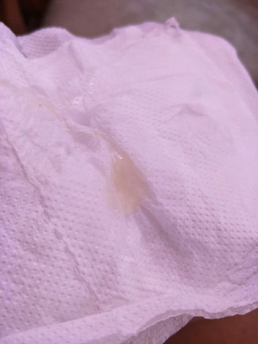 Mucus plug or ordinary discharge?