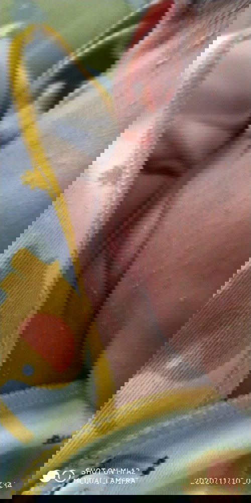 Bun,minta bantuannya dong Bun... seluruh tubuh anak sya pda bruntusan smua cara ngilangin/ngobatin😔