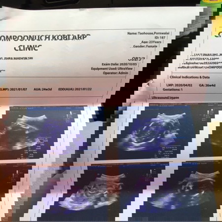 อัลตราซาวด์มา