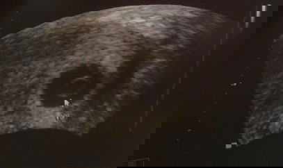 Week 6 Ultrasound without Heartbeat/ Fetal pole