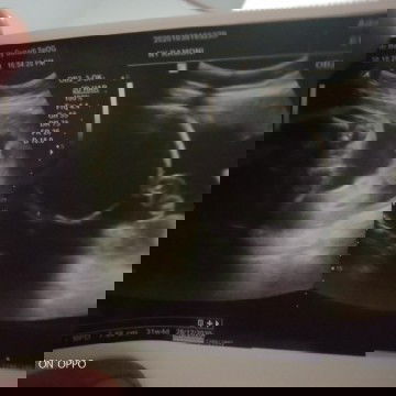 In bun mau nanya cara bacanya gimanyah soalnya aku bingung usia kehmila saya31 week