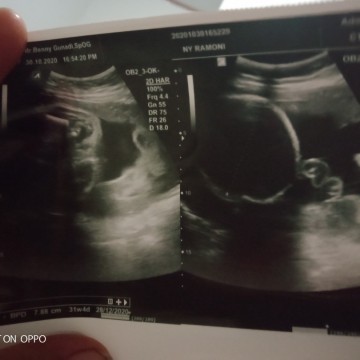In bun mau nanya cara bacanya gimanyah soalnya aku bingung usia kehmila saya31 week