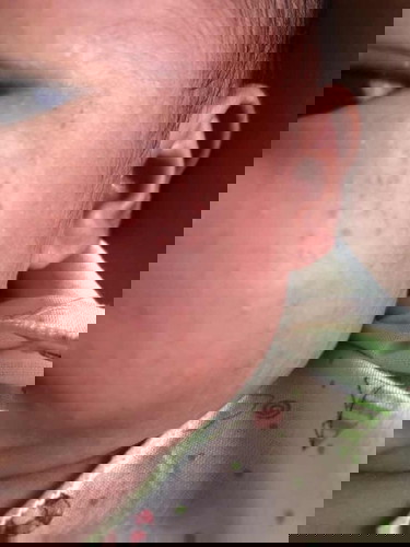 ลูกเป็นผดผื่นที่หน้า มีวิธีรักษาอย่างไรคะ