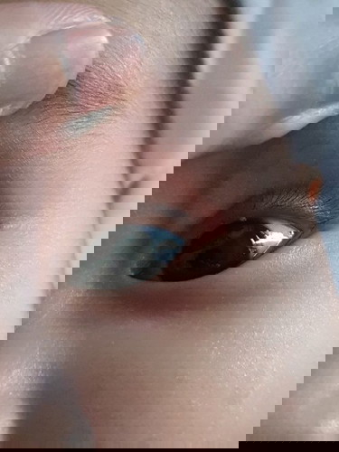 Small bump eyelid