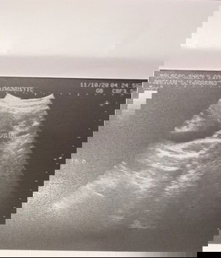 Sure napo kaya na girl ung baby ko mga momsh?