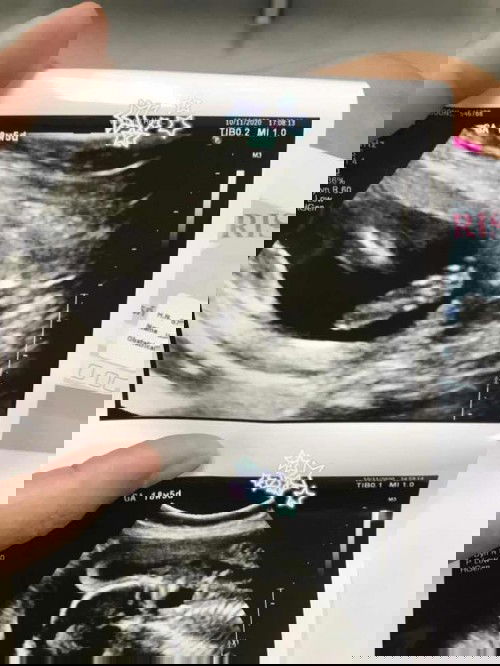 คุณแม่ท่านใดเคยตรวจMFM บ้างคะ