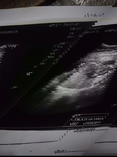 วันนี้ไปหาหมอมาค่ะหมอบอกน้องตัวเล็ก 14+5 w #ขอบคุณค่ะ