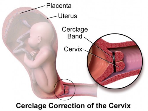 Cervical Cerclage at 20 weeks