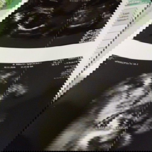 Bun. Sy hamil 32w6d.. Dan wktu d usg debay terlilit tali pusar.