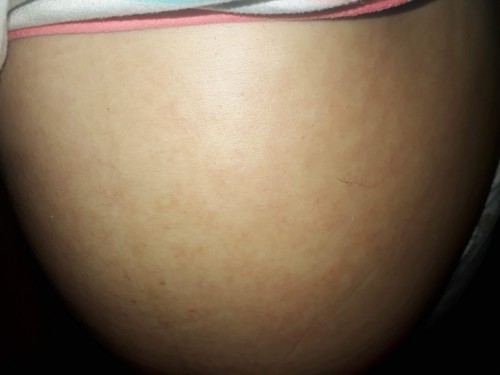 Preggy 27weeks with rushes