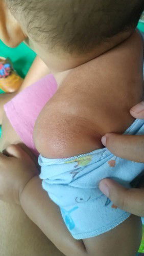 Ruam merah setelah demam