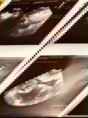 13 weeks and 5 days na si baby ๐