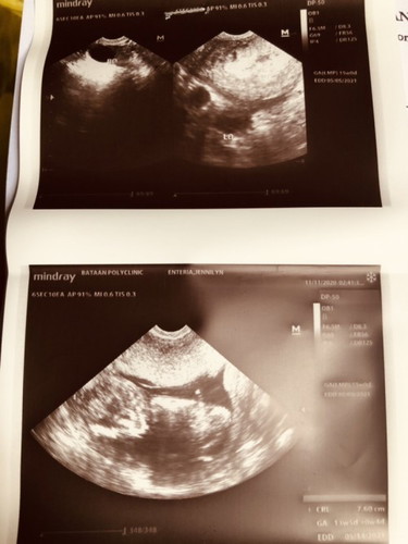 13 weeks and 5 days na si baby 😍