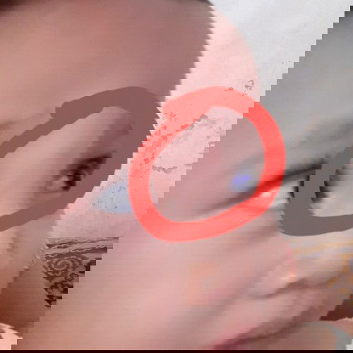 bentol pada bayi 14bulan