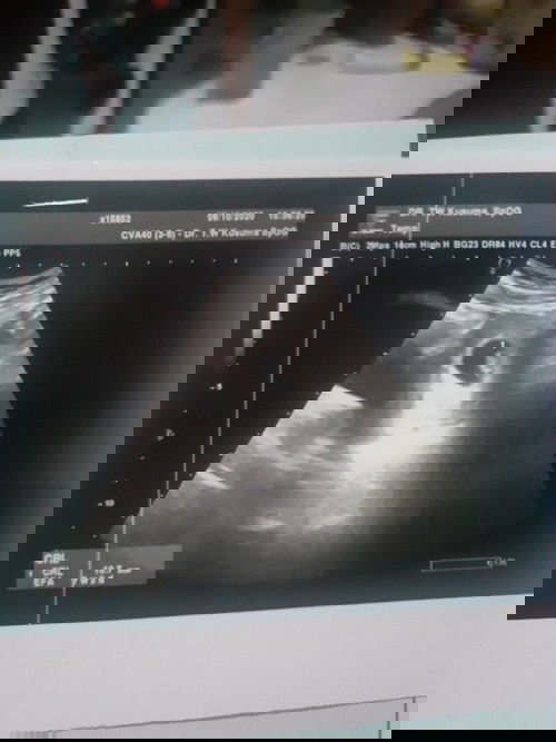 Detak jantung blm terdeteksi usia 11-12w