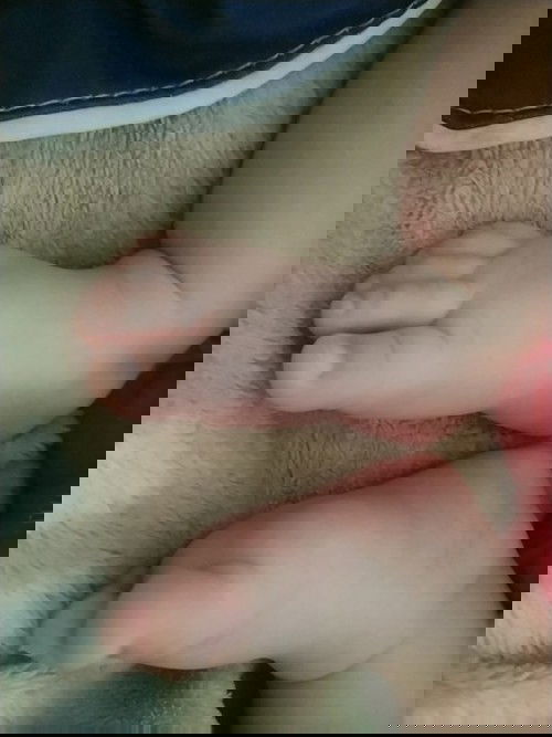 Bé 3 tháng bị lồi rốn có cách nào chữa hết k ạ