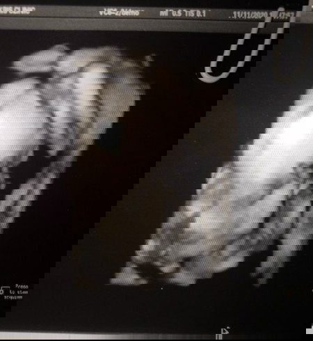 22 w 5 d กลับหัวแล้วผิดปกติไหมคะ