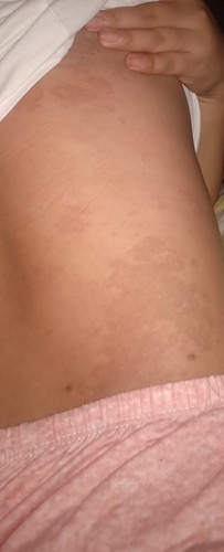 Skin problem
