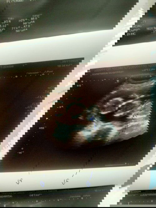 แฝดจ้า ยังไม่แน่ใจว่าชายหรือหญิง