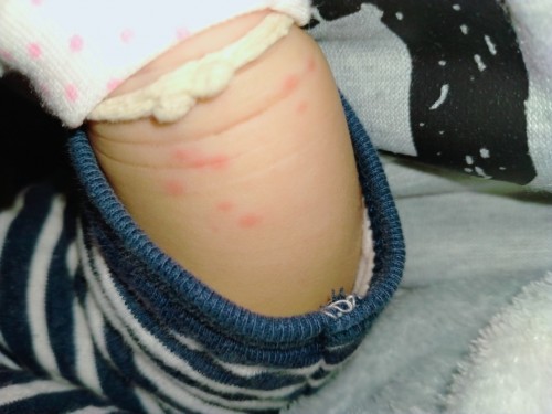 มือเท้าปาก