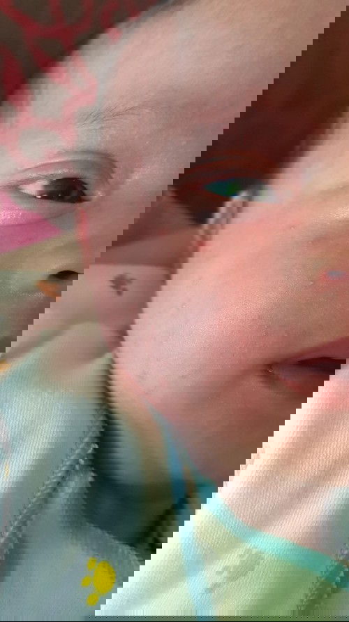 Bintik merah di sekujur tubuh hingga wajah dan kepala