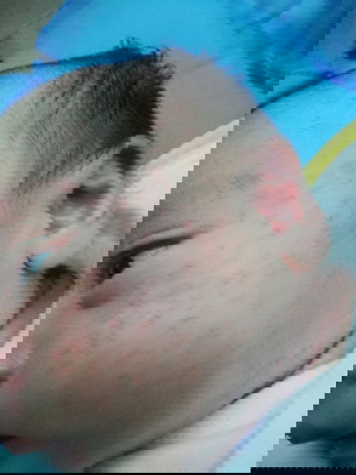 RASHES SA FACE NI BABY