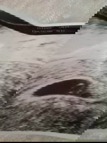 น้อง6วีคแร้วคะ แบบนี้ปกติไหมคะผลซาด์ ยังจับการเต้นหัวใจไม่ได้เรยคะรอตรวจรอบหน้าลุ้นว่าจะแข็งแรงไหม