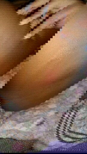 bekas imunisasi dpt bengkak dan keras