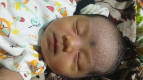 Anak saya di dahinya muncul beruntusan ada airnya gitu bun,Usia 5 hari bunda,
