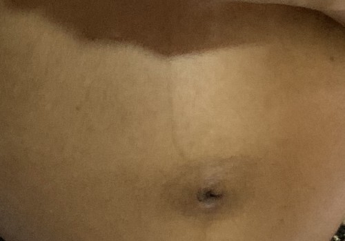 Black mark around belly button