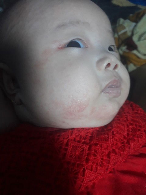 Nổi mẩn đỏ ở trẻ 2m20d
