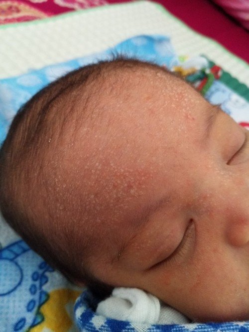 Bruntusan pada bayi