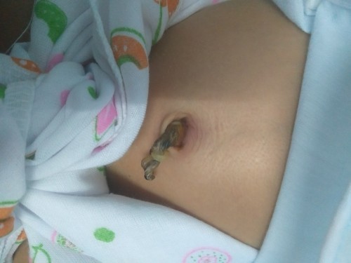 ขอสอบถามเรื่องสะดือลูกค่ะ