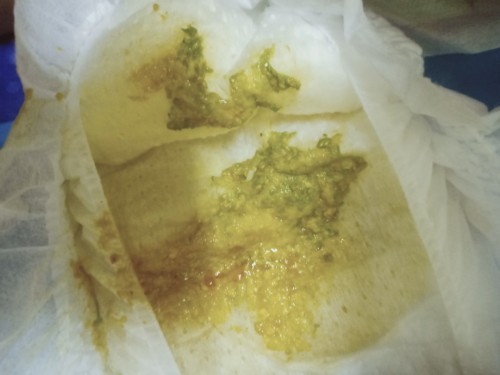 ลูกถ่ายมีมูกเลือด