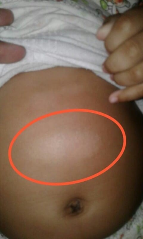 Kurap di perut bayi