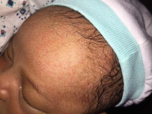 Skin rash??