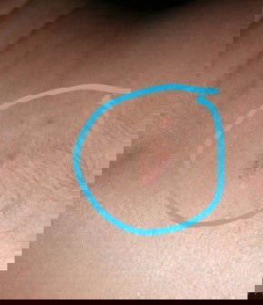 Beruntusan/ gatel di atas pantat