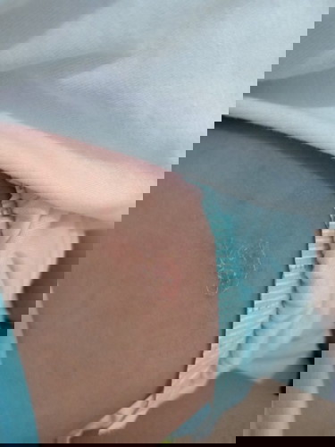 Sugat or rashes?