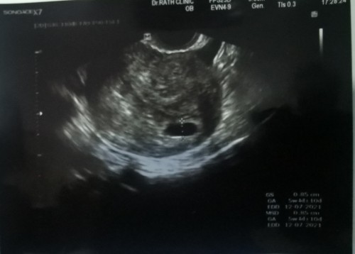 อายุครรภ์8สัปดาห์ยังซาวด์ไม่เห็นตัวเด็ก