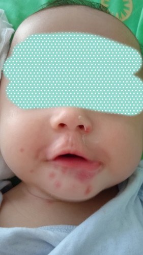 Pamumula at pagsusugat