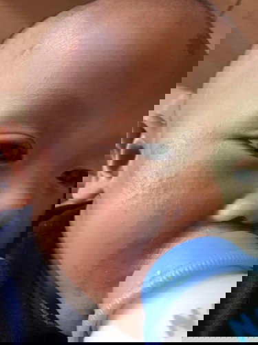 ผื่นบนหน้าหน้าน้องรักษายังไงค่ะ