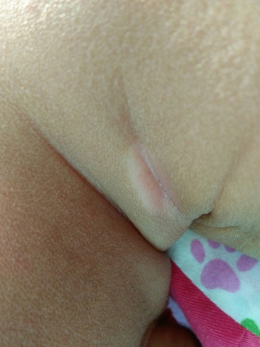 lipatan di leher bayi