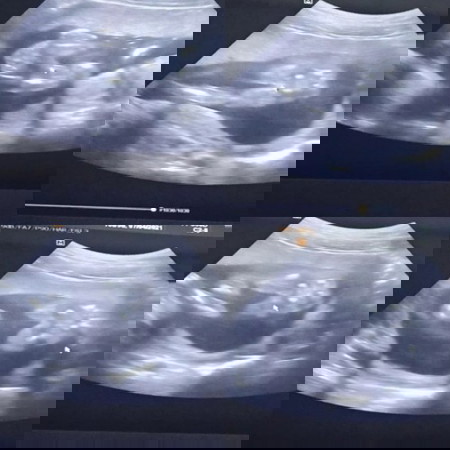 รู้เพศลูกตอน18week5day ชัวร์รึยัง
