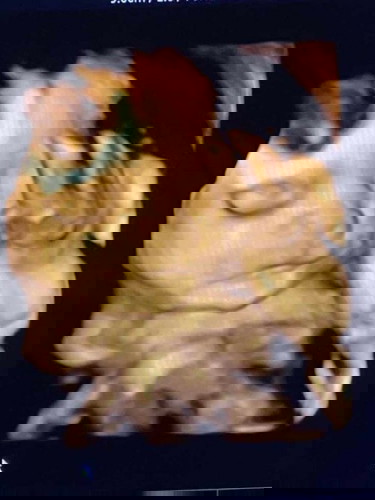 24w5d ลูกสาว