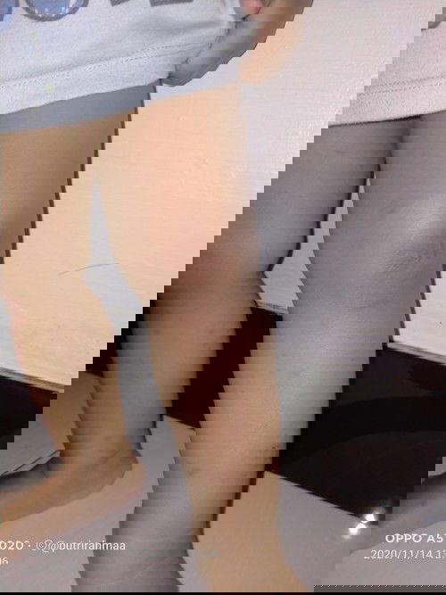 bekas gigitan nyamuk atau apalah itu