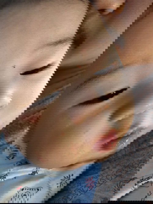 ผื่นแดง ผื่นขึ้นหน้า