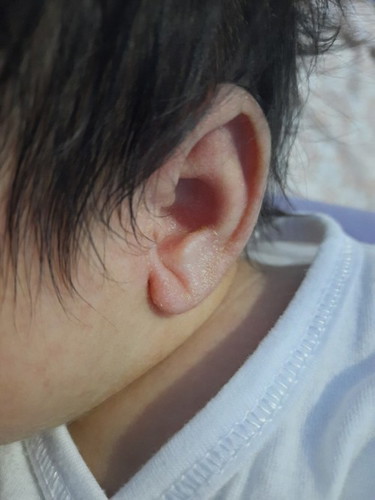 Ear infection